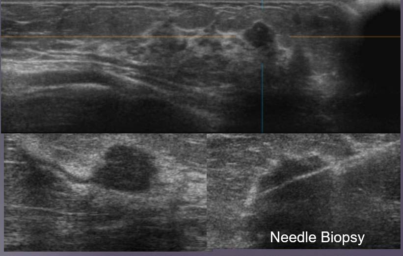 Needle Biopsy Breast MRI Like ultrasound, increased