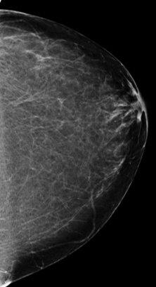 What are Dense Breasts?