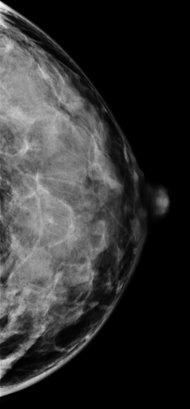 1000 women is found in dense breast tissue