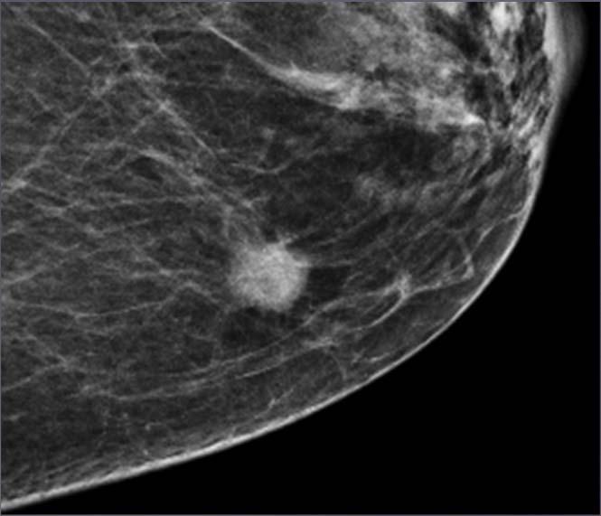 Breast Cancer Risk Up To