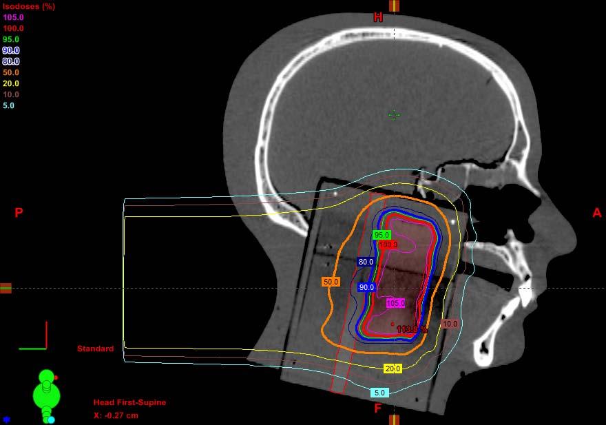 Figure 2-4: Spot scanning treatment plan shown in the sagittal plane Figure 2-5: DVH of spot scanning