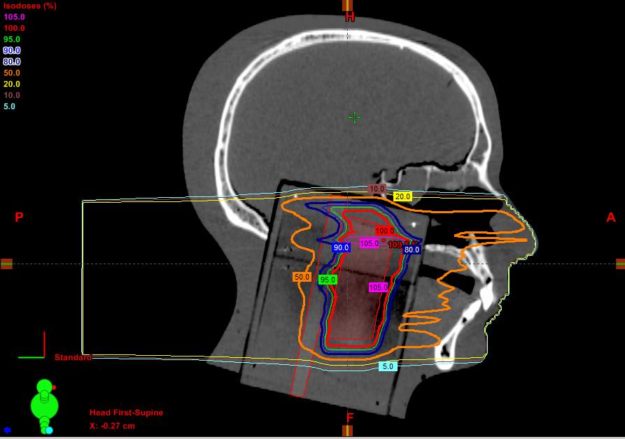 Figure 2-9: Sagittal view of isodose lines of passive scattering plan The impracticality of the plan can be analyzed further through the DVH created by the
