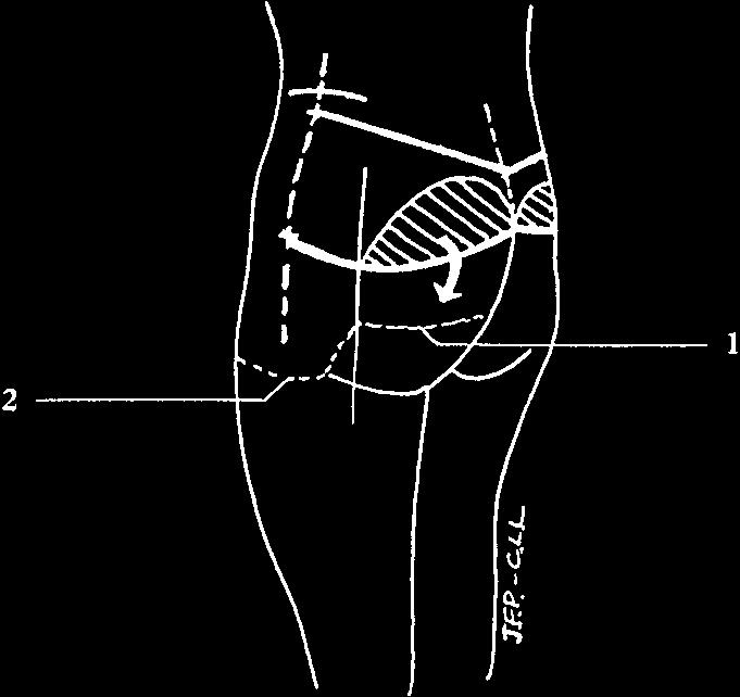 1, Undermining area for the flat; 2, Undermining area for suspension points. attractive curve in the lower back which may appear totally straight.