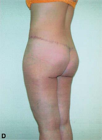 Cutaneous necrosis is not possible either, given the depth of the region that is operated on and limited undermining. Substantial quilting sutures make seromas unlikely.
