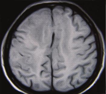 2 Case Reports in Neurological Medicine (a) (b) (c) (d) Figure 1: Cranial magnetic resonance imaging (MRI) shows multiple dural-based enhancing lesions on unenhanced