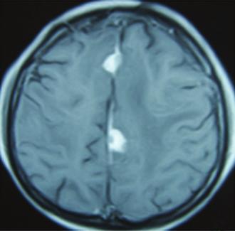 The imaging findings of pachymeningeal TB are reported as follows: on plain computed tomography scans the lesions appear hyperdense while they appear isointense to brain parenchyma on T1-weighted MR