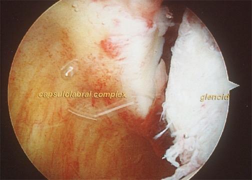 Pathology Acute Dislocation there is stretch of the IGHL Bigliani et al J Ortho Res 1992 Ticker, Bigliani et al JSES 1996 McMahon, Lee TQ