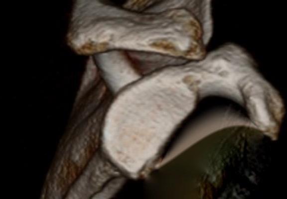 Re-defining Critical Bone Loss 72 arthroscopic repairs 4 quartiles of bone loss: 13.