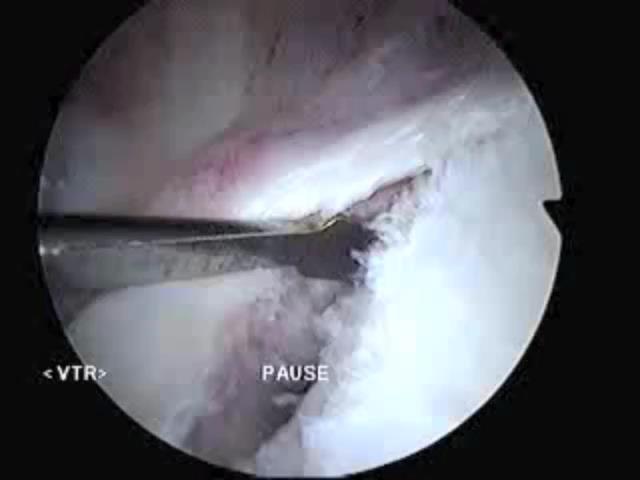Let them have another dislocation Articular surface lesions - Glenoid, Humeral Head