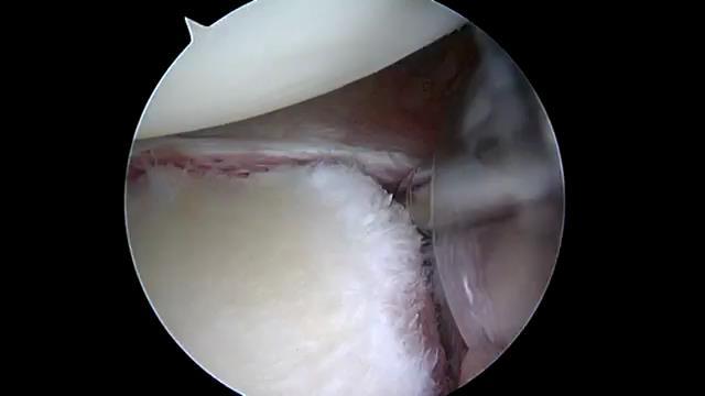 arthroscopy after 1st event: Bankart lesion now