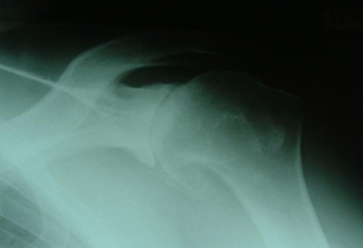 The cost of recurrent instability: Articular surface lesions -Glenoid, Humeral