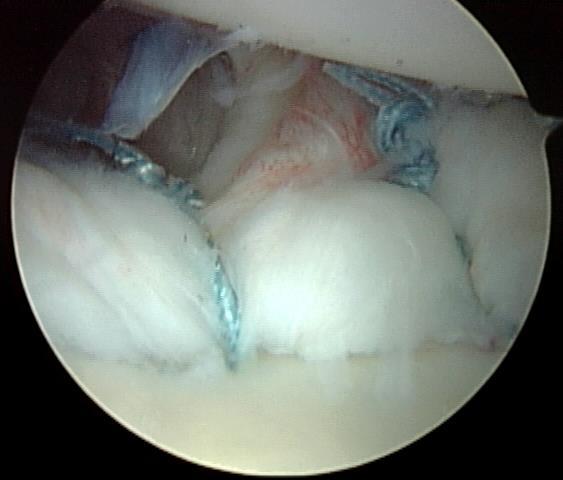 Arthroscopic Primary Repair Standard has changed: active, athletic patients< 25 years old Natural history Pathoanatomy: optimum