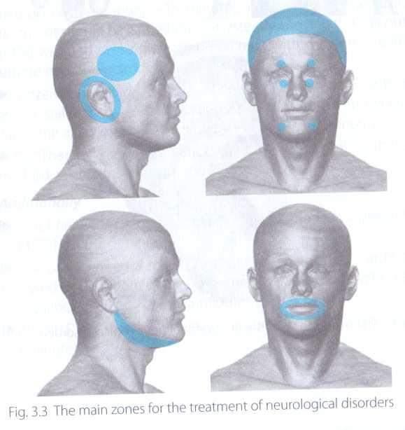 6. 7. Speech zones: zone around the mouth, submandibular zone are treated in cases involving speech disorders. Additional zones for course of treatment 1.
