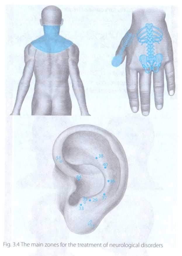 7. METHODS OF DEVICE IMPACT Headache, dizziness (tension headache, intracranial hypertension, migraine, diseases and the effects of injuries of the cervical spine) The purpose of DENS is to get rid