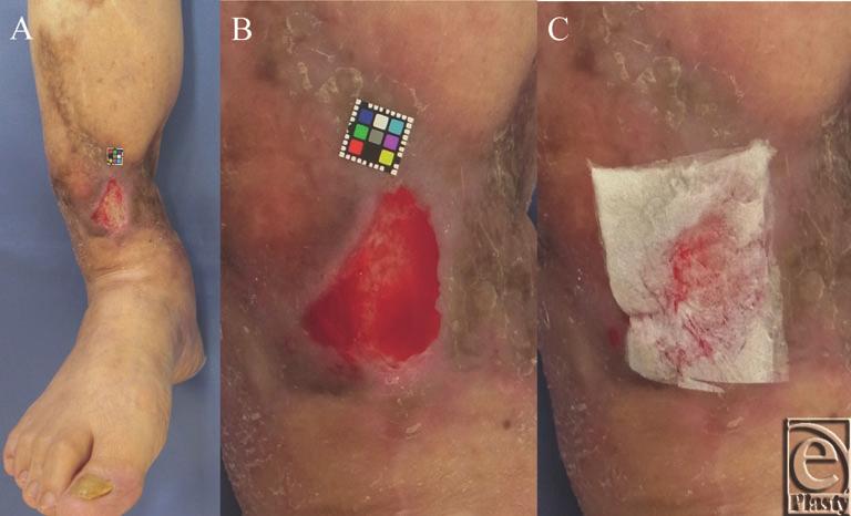eplasty VOLUME 16 CASE REPORT A 68-year-old woman had suffered open fracture of her right tibia 2 years prior, and a split-thickness skin graft had been applied to repair the full-thickness skin