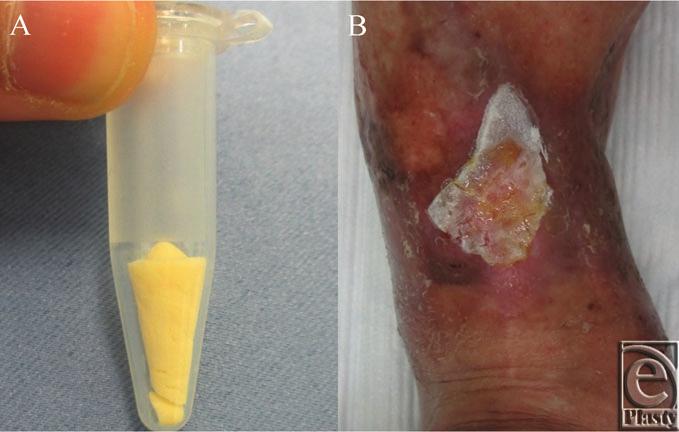 eplasty VOLUME 16 Figure 3. The gross appearance of freeze-dried PRP and its application to the wound. (a) Freeze-dried PRP preserved in a 1.5-mL microcentrifuge tube.