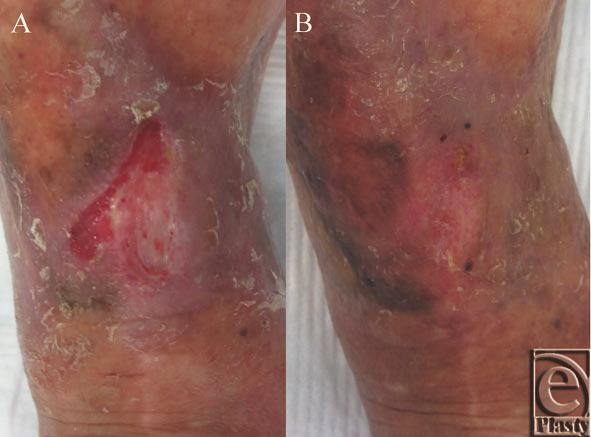 PRP indicates platelet-rich plasma. Figure 4. The gross appearance of the wound at 37 days (a) and 9 months (b) after the first PRP application.