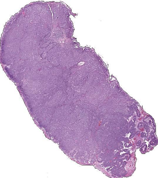 T-category determined by Breslow thickness and ulceration