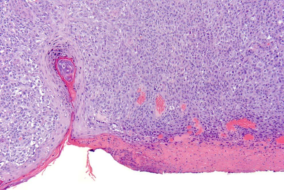 T-category determined by Breslow thickness and ulceration Ulceration Absence of intact epidermis with accompanying host reaction overlying invasive