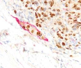 Absent Non-Brisk Brisk Lymphovascular invasion IHC aided detection may