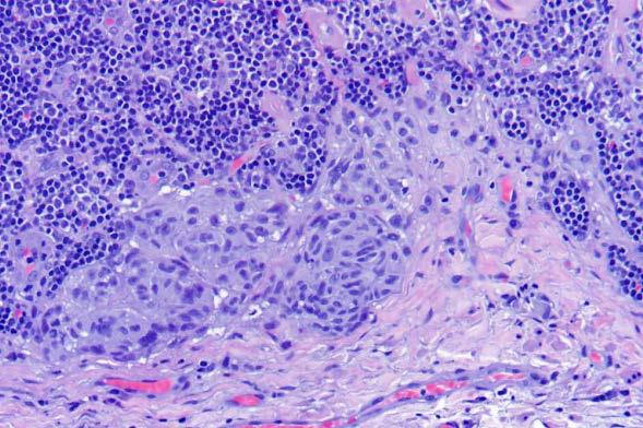 Isolated cells in the SLN are significant Criteria for positive lymph node: Any tumor deposit size Isolated IHC+ tumor cell