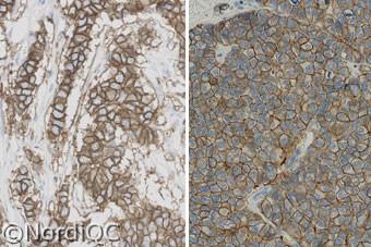 Fig. 3a Left: Staining for HER-2 of the breast ductal carcinoma no. 5 with a HER-2/Chr. 7 ratio > 6.0. membranous staining corresponding to 3+.