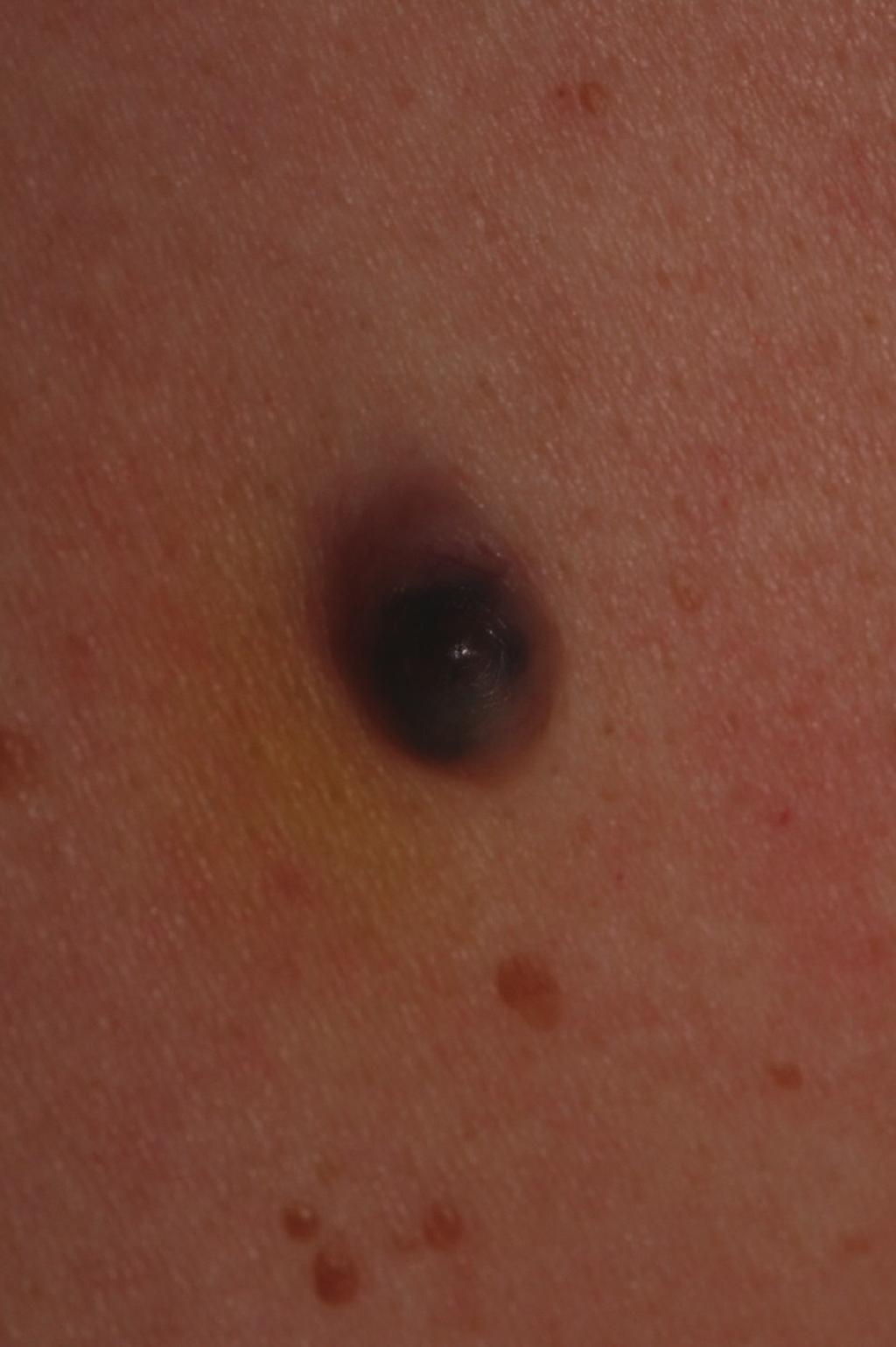 Figure 2: Dermatoscopic examination showed a homogenous blue/black area and arborizing telangiectasia. Noninvasive procedures have been developed for the diagnosis of skin cancers [4 7].