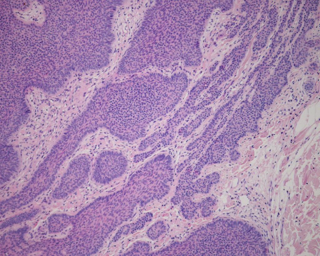 blue/black area with arborizing telangiectasia. 500 µm Abbreviations Figure 4: Histological examination showed multiple variably sized nodules with continuation of the epidermis.