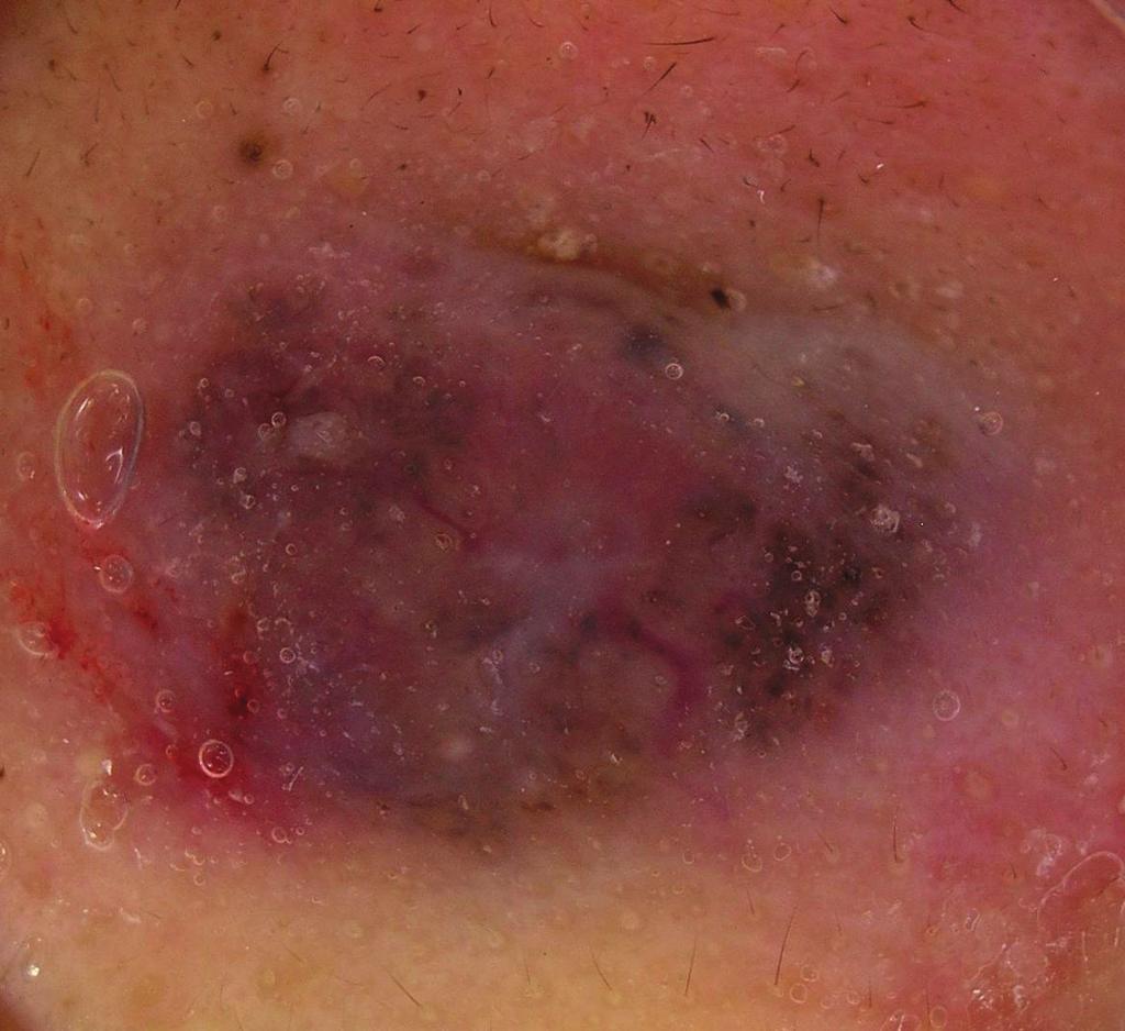 , Dermatoscopy of basal cell carcinoma: morphologic variability of global and local features and accuracy of diagnosis, the American Academy of Dermatology, vol. 62, pp. 67 75, 200. [2] D.