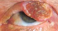 Squamous cell carcinoma Usually more