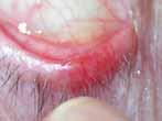 characteristic appearance masquerader May present as unilateral blepharoconjunctivitis