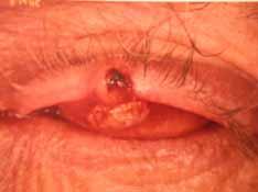 suggest sebaceous cell carcinoma More common on upper lid more meibomian glands in the