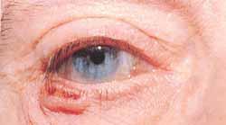 Characteristics of malignancy Diagnosis starts with suspicion Treatment rests on complete surgical excision The most common skin malignancy is basal cell carcinoma (BCCa) >90% of malignant lid