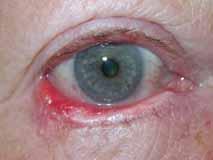 tumor outgrowing its blood supply Morpheaform BCC Madarosis & eyelid margin architecture change due to basal cell carcinoma