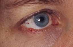 Recurrence should also raise suspicion Basal cell carcinoma (BCC) The most common skin malignancy 90% of eyelid malignancies