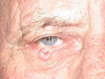 Basal cell carcinoma Neglected basal cell carcinomas Low risk for metastasis May invade locally Mortality 3% Morbidity & mortality