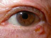 Nodular most common Morpheaform or sclerosing Superficial least common on eyelids Nodular basal cell carcinoma Firm, raised, pearly