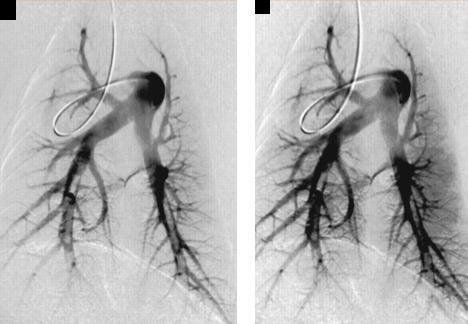 - Definitively diagnoses or excludes P.E but is invasive 50. - Contrast injected into pulmonary artery branch after percutaneous catheterization of femoral vein.