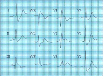 ) - Normal duration of QRS = 0.