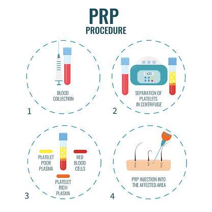 PRP Preparation Withdrawal of patient peripheral blood