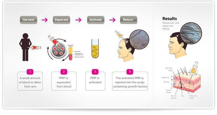 Hair Restoration PRP Procedure - Mix thrombin Bovine origin 5000 IU with 5 cc Calcium Chloride 10% 13.