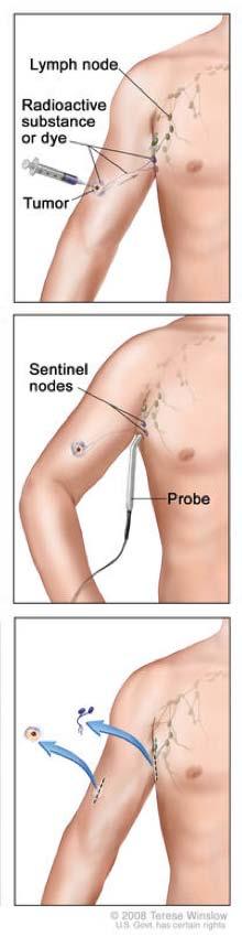 Sentinel Lymph Node Biopsy First described by Dr.