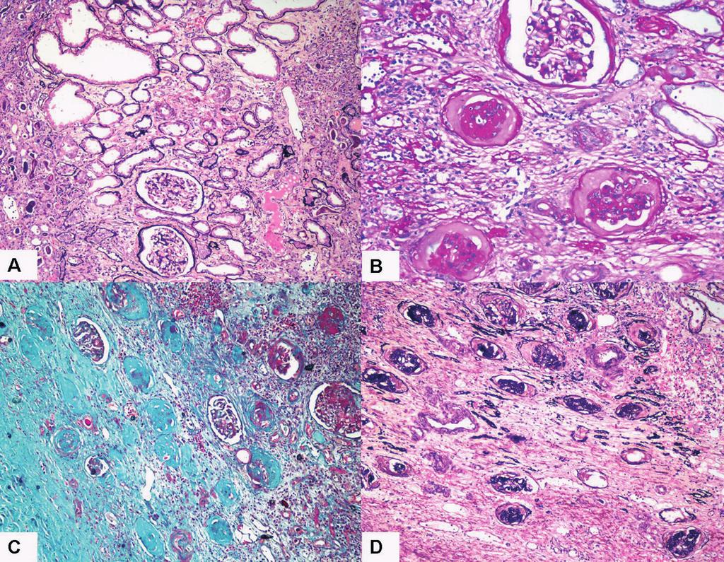 CMYKP Evolution of the approaches toward grading and classifying chronic changes in the renal allograft: Banff classification updates III closely the specific features of chronic changes in the