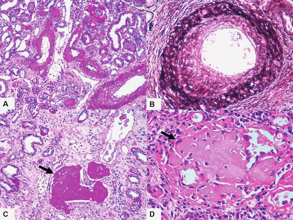 CMYKP Figure 2 Morphological features of some specific diseases causing interstitial fibrosis and tubular atrophy (IFTA) of the renal allograft. A.