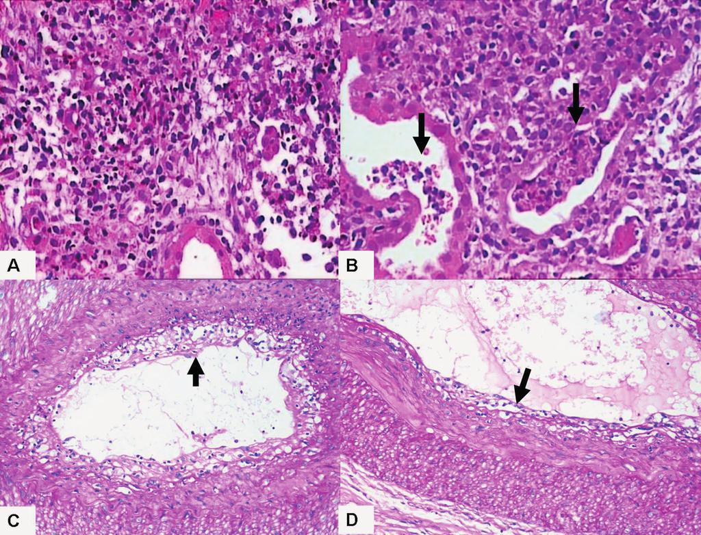 CMYKP Evolution of the approaches toward grading and classifying chronic changes in the renal allograft: Banff classification updates III Figure 3 Morphological features of some specific diseases