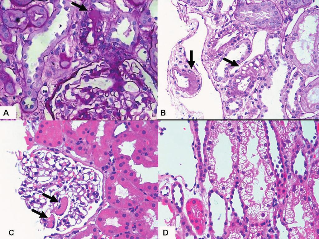 CMYKP Figure 4 Morphological features suggestive of calcineurin inhibitor (CNI) toxicity. A.