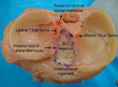 Tibial insertion of ACL is close to the attachment of anterolateral meniscal root (ALMR).