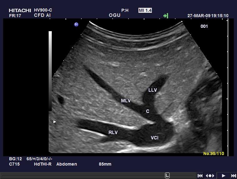 Ultrasound of the liver. 11.04.2018 10:01 8 Figure 1 First level, confluences of the hepatic veins.