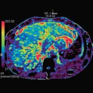 HCC treatment assessment (continued) Perfusion Findings The perfusion maps clearly show an area of increased AF, reduced PF, and increased PI between the previously treated