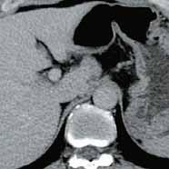 The triphasic CT study showed a 23 mm hypoattenuating nodule over segment 1 (arrows).
